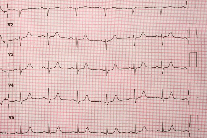 heart rate electrocardiogram
