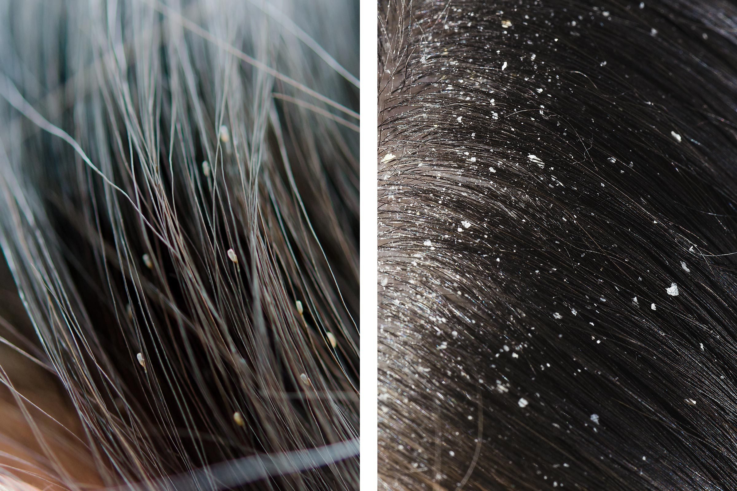How to Spot the Difference Between Lice and Dandruff | Reader's Digest