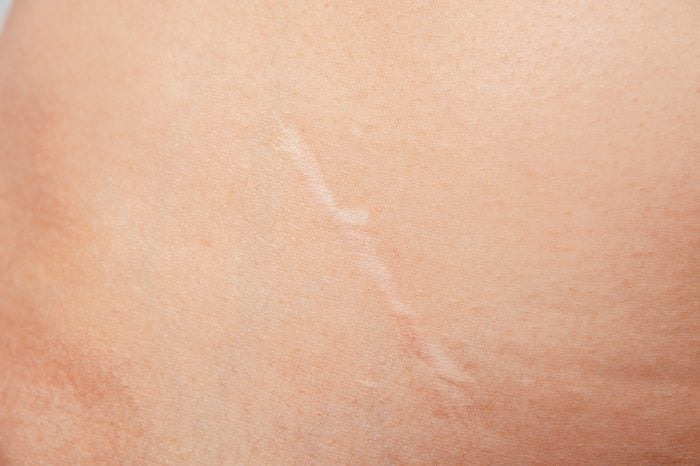 Scars removal concept. Young woman with large scar after surgery on abdomen, removal of appendicitis.