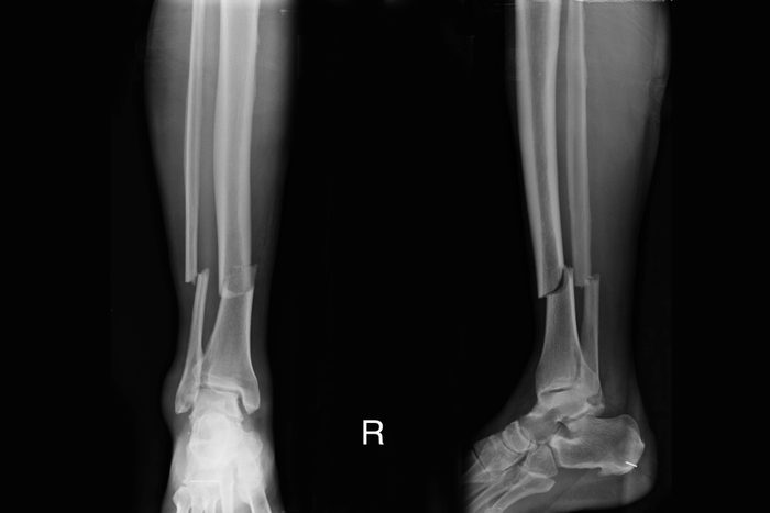 Xray image show closed fracture right leg