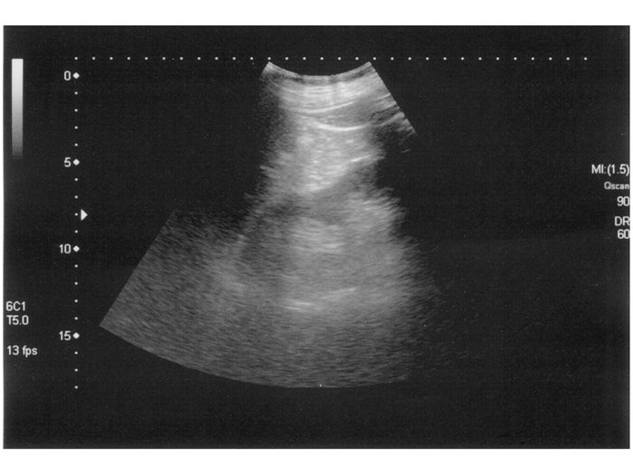 Ultrasound scan medical imaging of abdomen diagnosing gallstones