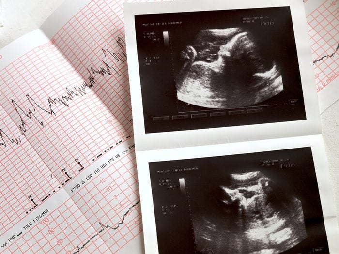 ultrasound portrait of the fetus and cardiogram results