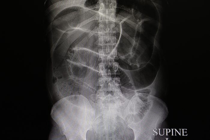 an abdominal xray film of a patient with complete large intestinal obstruction, shown with dilated loops of large and small bowels