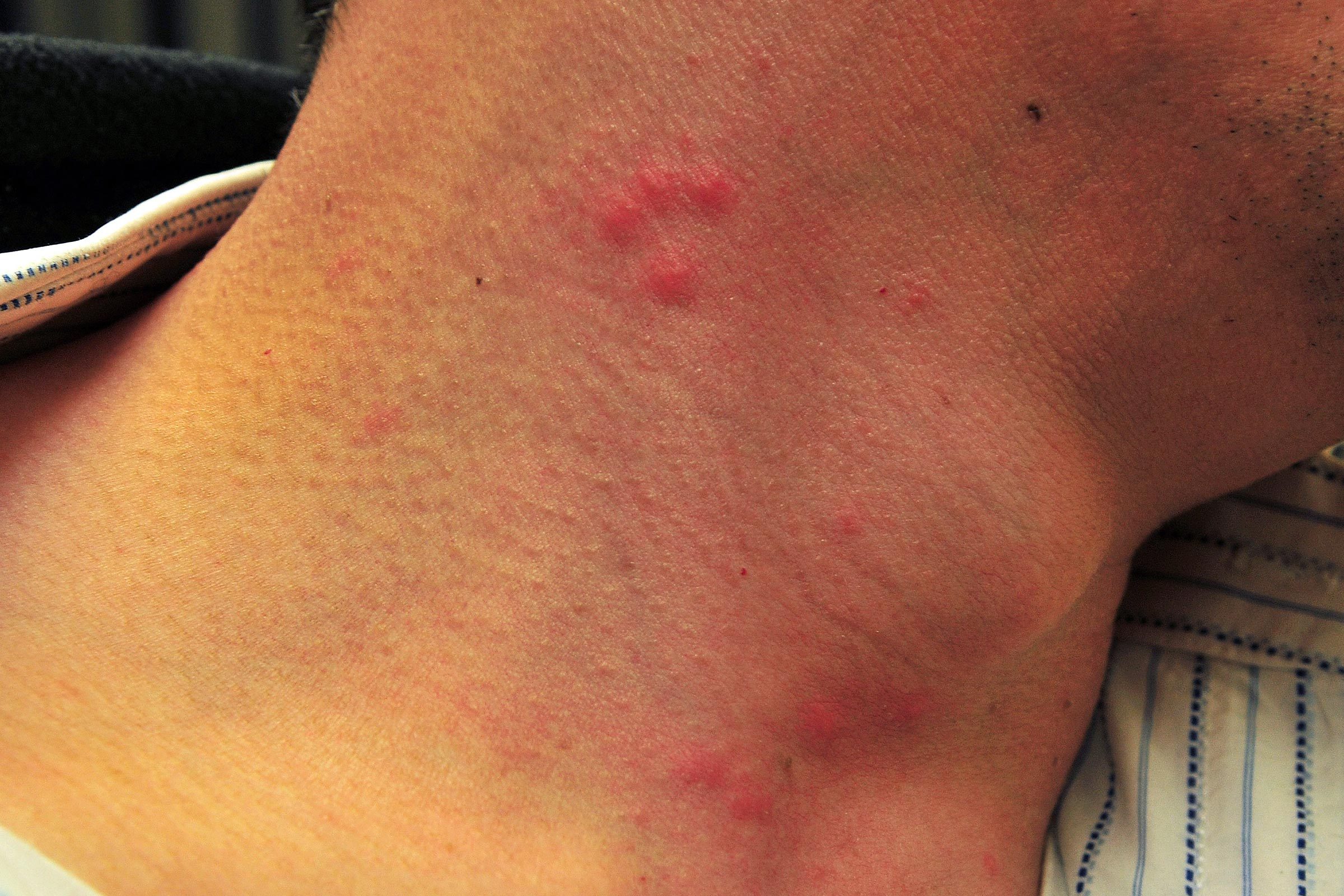 bed bug bites how to identify and treat