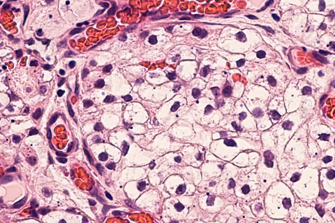 kidney cancer cells microscope