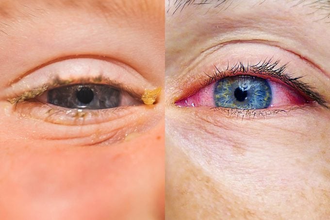 pink eye vs allergies
