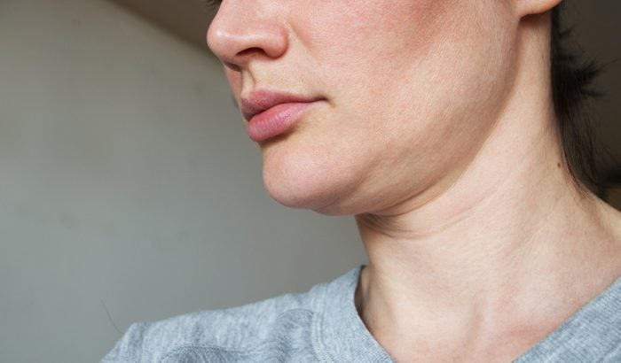 sagging chin. face line correction
