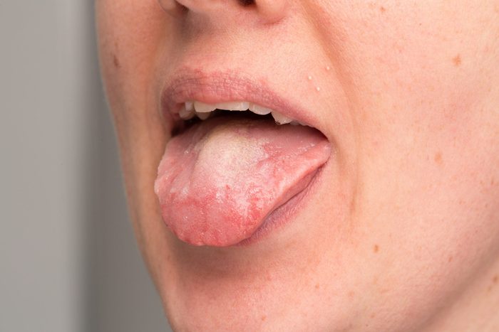 Candid albicans infection on tongue of woman
