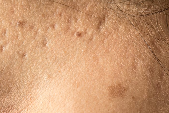 Pocked skin with acne marks