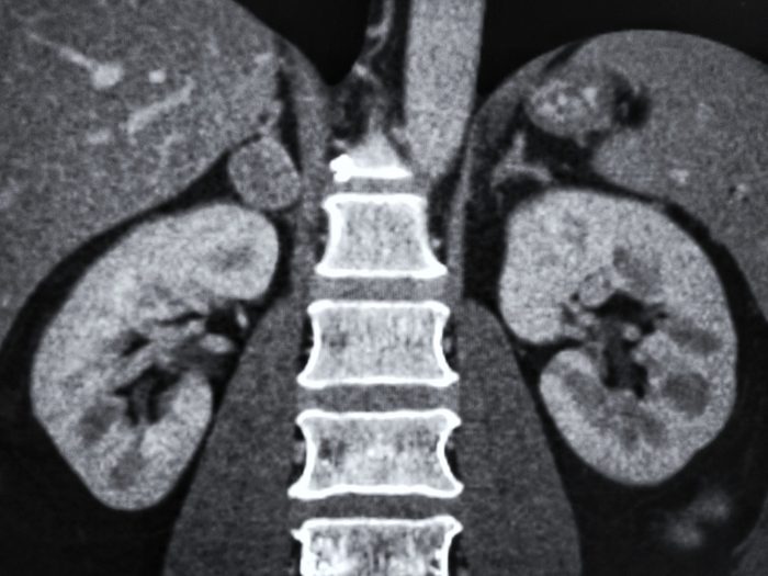 CT scan showing normal both kidneys and right adrenal tumor