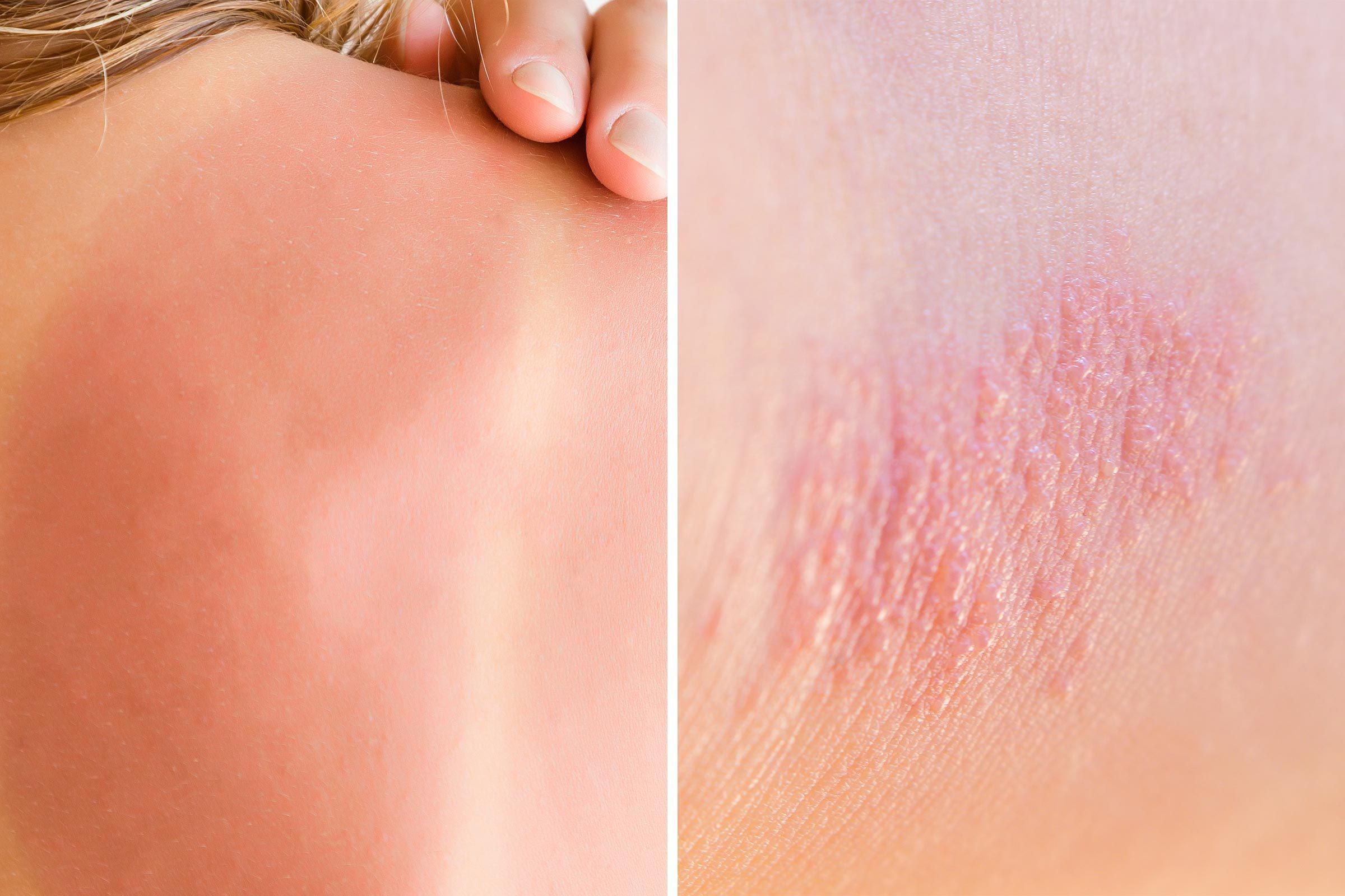 Heat Rash or Sunburn: Here’s How to Tell the Difference | Reader's Digest