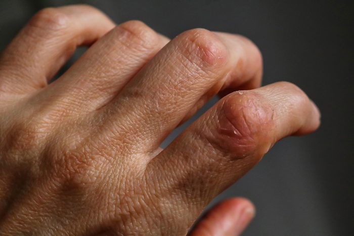 Psoriasis. A close view of skin affected by psoriasis on hands. Psoriasis patches on fingers and knuckles.
