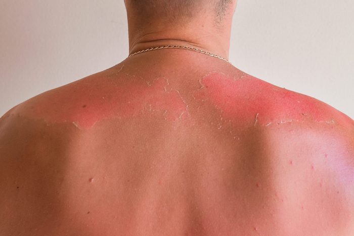 Sunburned man. Sunburned heavily, white skin versus very dark red and burned