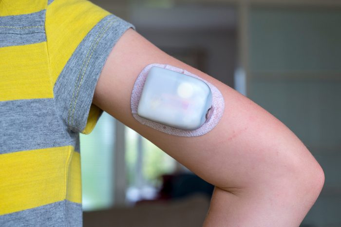 An Omnipod diabetes management Insulin Pump on a girls arm
