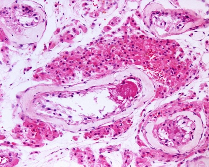 Large cluster of Leydig cells in a case of Klinefelter syndrome, characterized by a 47, XXY karyotype. The hyperplasia of the testicular interstitium is typical of this syndrome. 