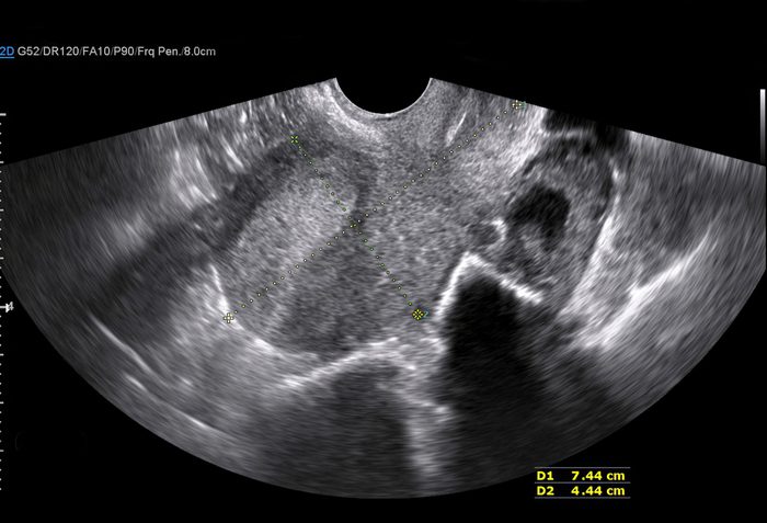 Transvaginal ultrasound of uterus. Bicornuate uterus. Transverse 2D image illustrating two distinct endometrial cavities with arrows. Scientific diagram.; Shutterstock ID 1480869854; Job (TFH, TOH, RD, BNB, CWM, CM): RD
