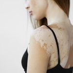 Vitiligo: Understanding This Autoimmune Condition
