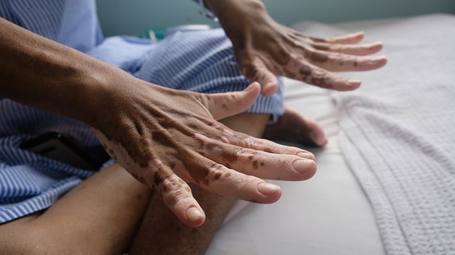 Vitiligo on hands of a patient secondary to steroids effect.