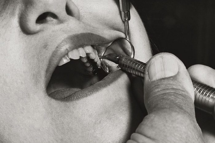 Dentist Drilling Inside a Mouth
