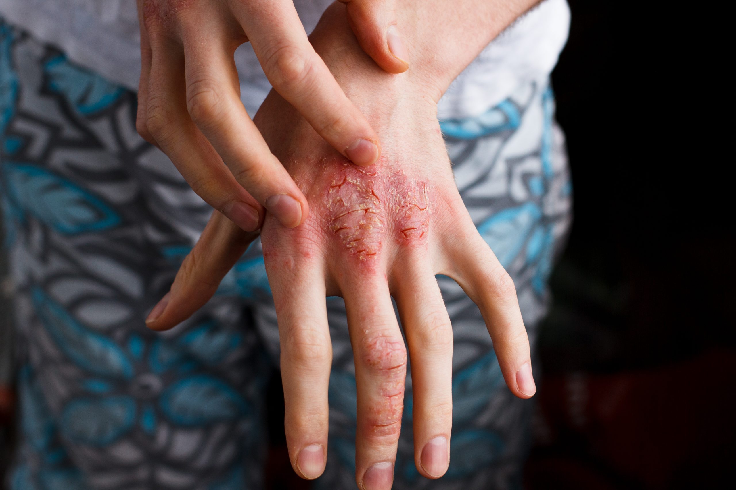 Closeup,men,itching,and,scratching,by,hand.,psoriasis,or,eczema