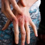 Atopic Dermatitis: Understanding the Most Common Type of Eczema
