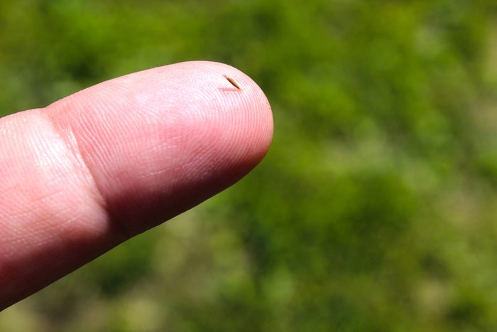 A splinter in the finger close-up.