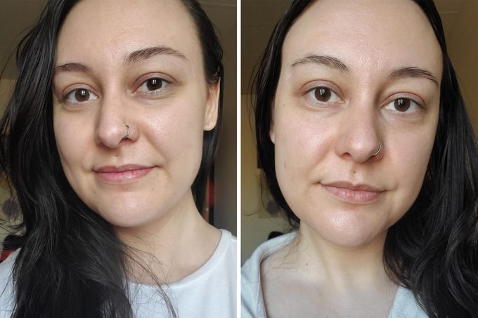 Before And After Personal Microderm Elite Pro