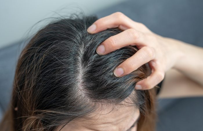 Close up of Dandruff problem on woman head. Dandruff is a skin condition that causes itchy.