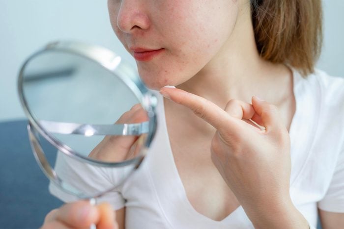 Cropped shot of woman applying acne cream on her skin for solving acne problem