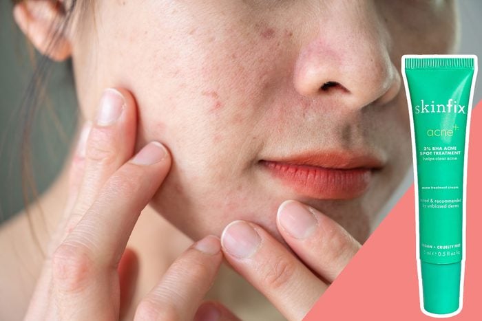 Treat acne gently and effectively