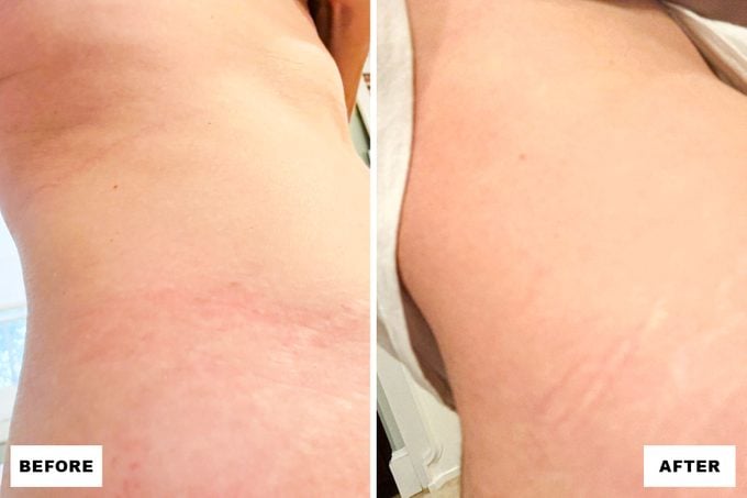 Peter Thomas Roth Stretch Mark Cream Before and After Results