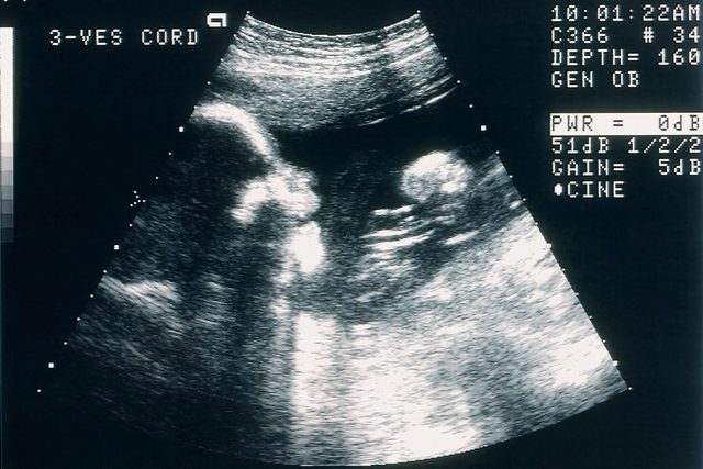 Sonogram of human fetus (B&W)