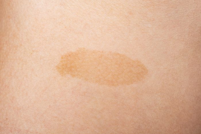 skin cancer closeup, yellow birthmark on the skin