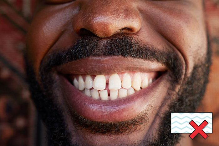 man smiling with teeth with a "no magic eraser symbol" in the corner 