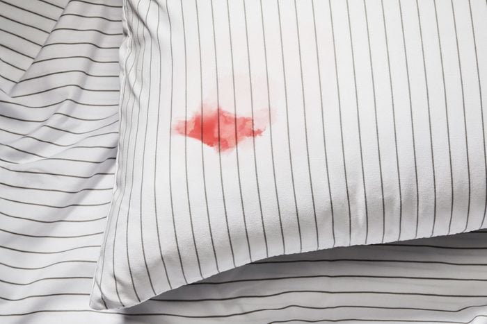 Blood stain on the sheets of a pillowcase