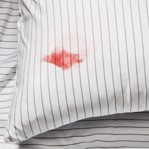 Blood stain on the sheets of a pillowcase