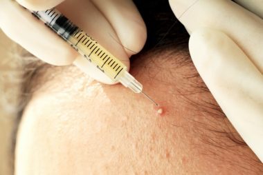Steroid injection into cystic acne