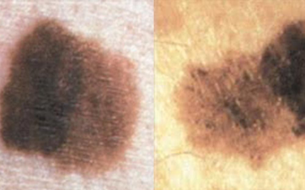 Black Spots On Skin Bellevue Laser And Cosmetic Center Lumps And