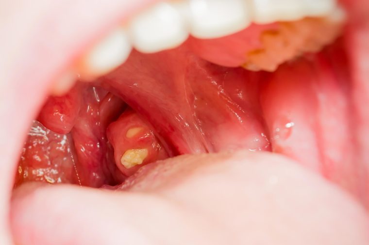 Sore throat tonsils adult